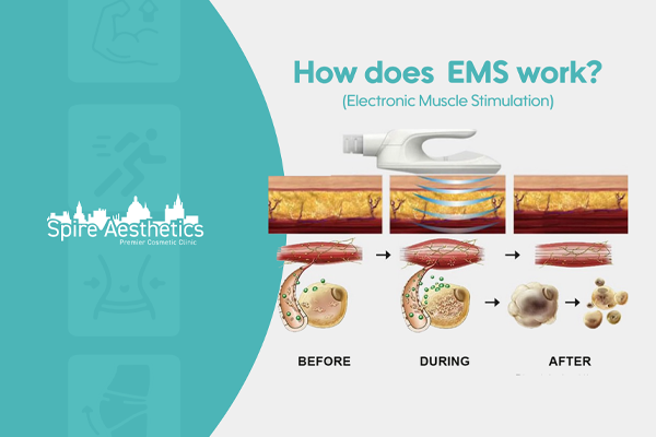 EMS treatment for post pregnancy weight loss treatment Sunningdale