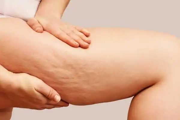 Image of woman showing leg with cellulite Sunningdale
