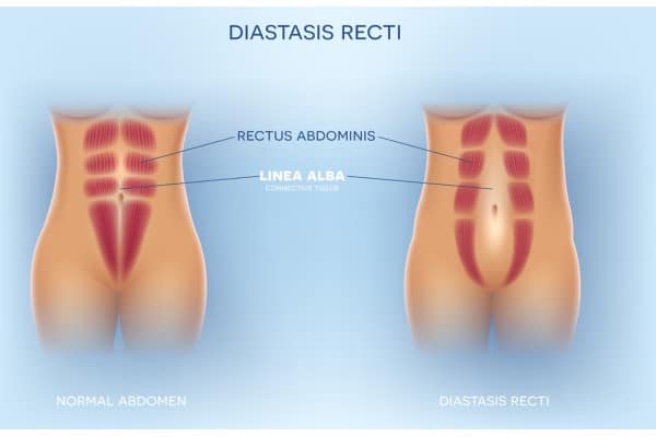 What Non-Surgical Options Are Available for Diastasis Recti Sunningdale?