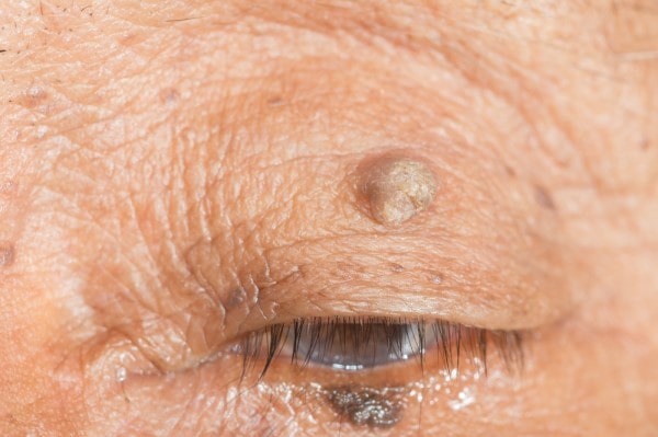 Skin imperfections Sunningdale - Cryopen is fast and effective book in today!