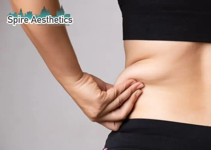 Image of woman pinching fat on their hips Sunningdale. Fat Freezing treatment