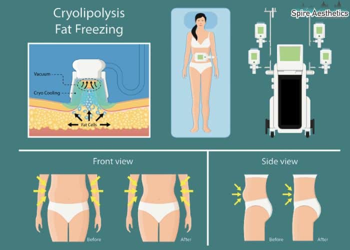 Image of diet and fat freezing combined for best results for Spire Aesthetics Sunningdale