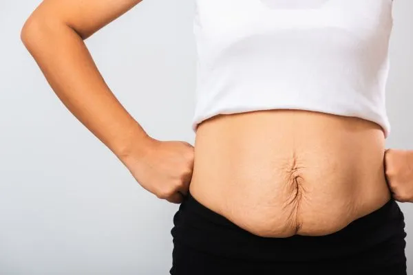 Image of a woman's stomach after weight loss with sagging skin following a gastric band Sunningdale