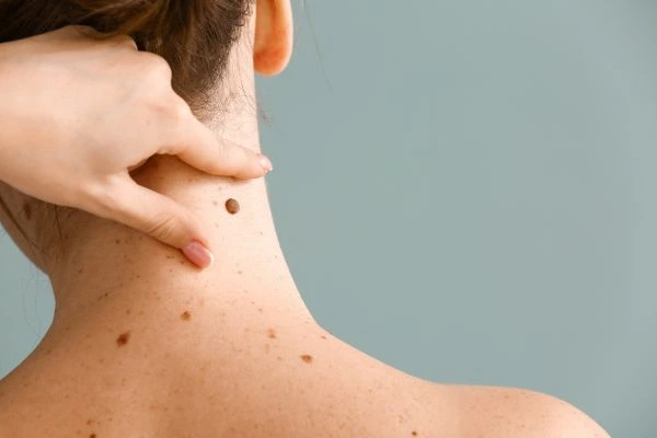 skin blemish removal Sunningdale treatment
