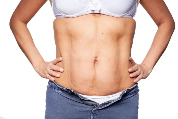 sagging skin on woman's stomach after weight loss injections Sunningdale
