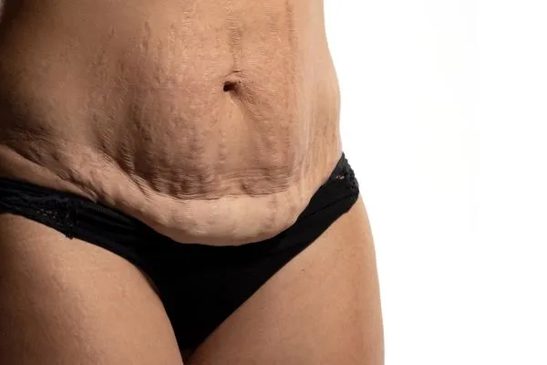 Image of womans stomach after weight loss injections Sunningdale showing saggy skin
