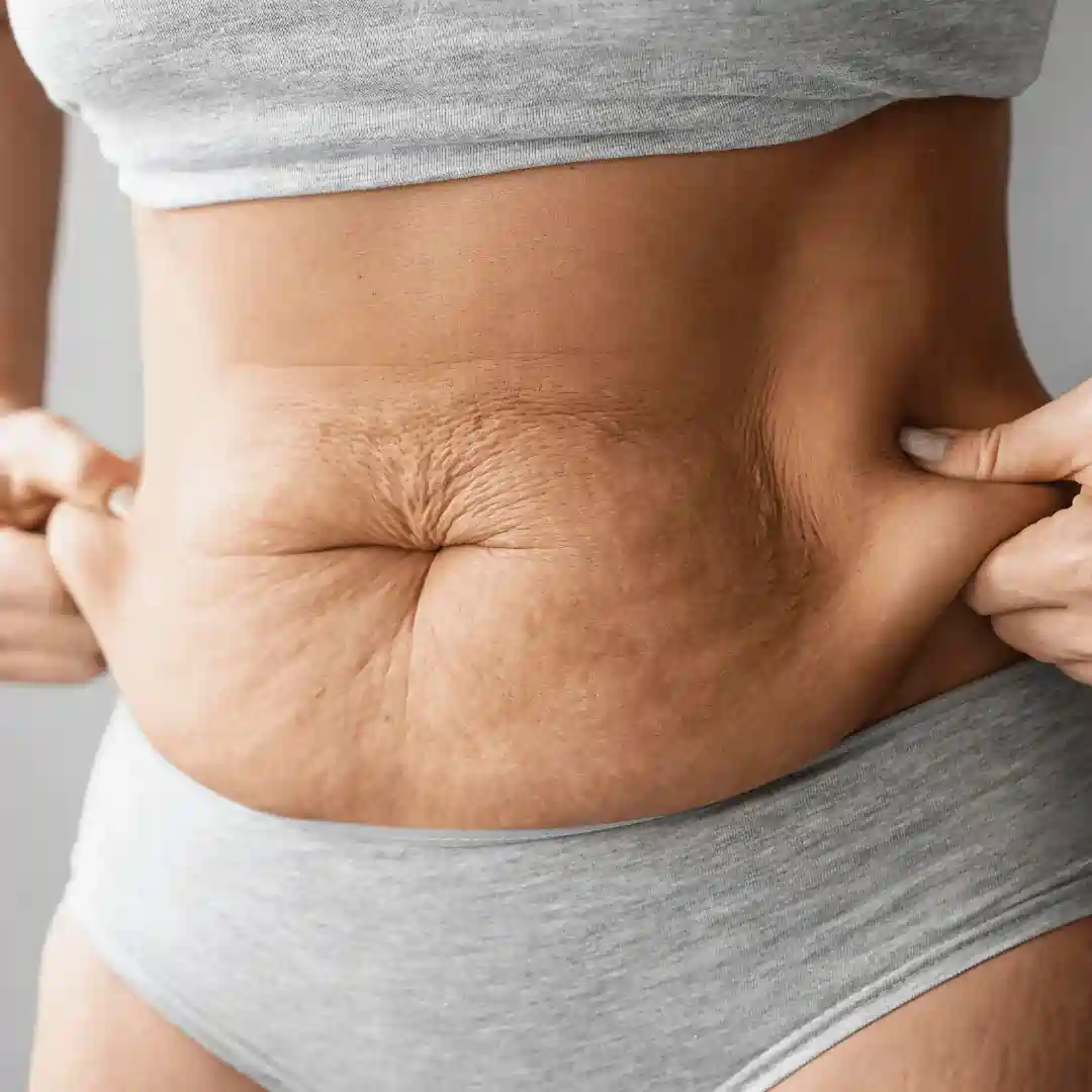 Is It Normal to Have Loose Skin After Pregnancy Sunningdale?