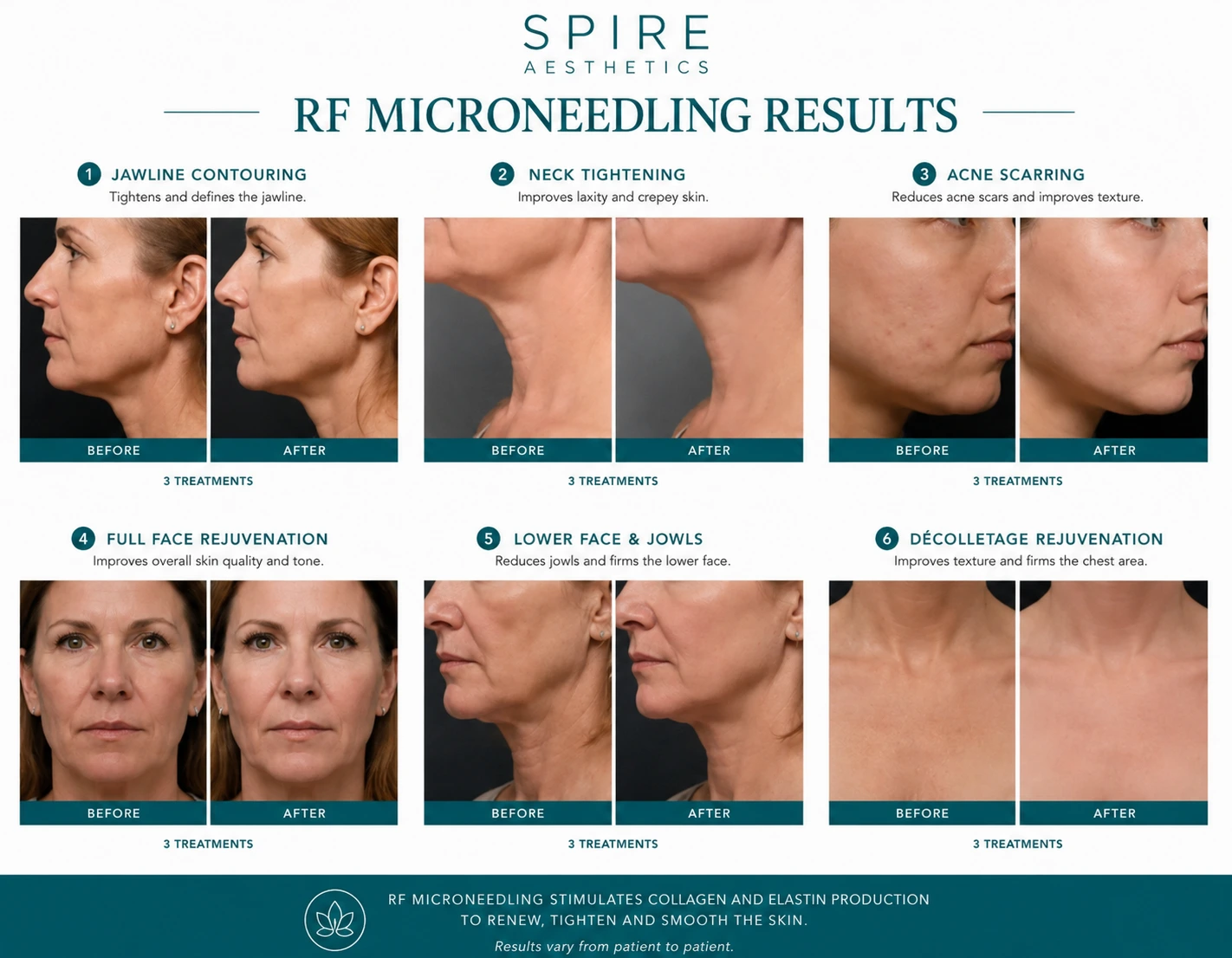 RF Microneedling Skin tightening Sunningdale results