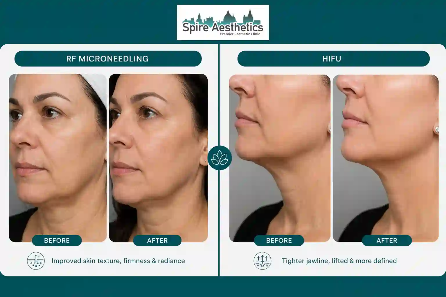 Can RF Microneedling and HIFU Be Combined Sunningdale?