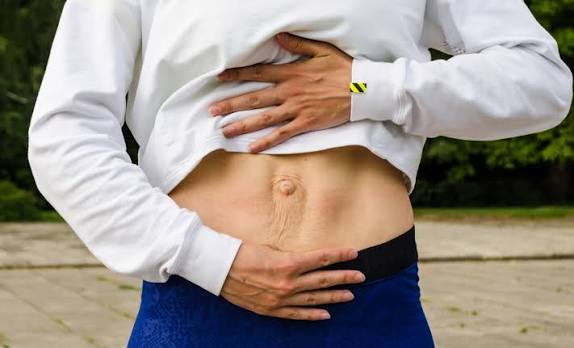 When Could Diastasis Recti Be the Missing Piece of the Puzzle Sunningdale?