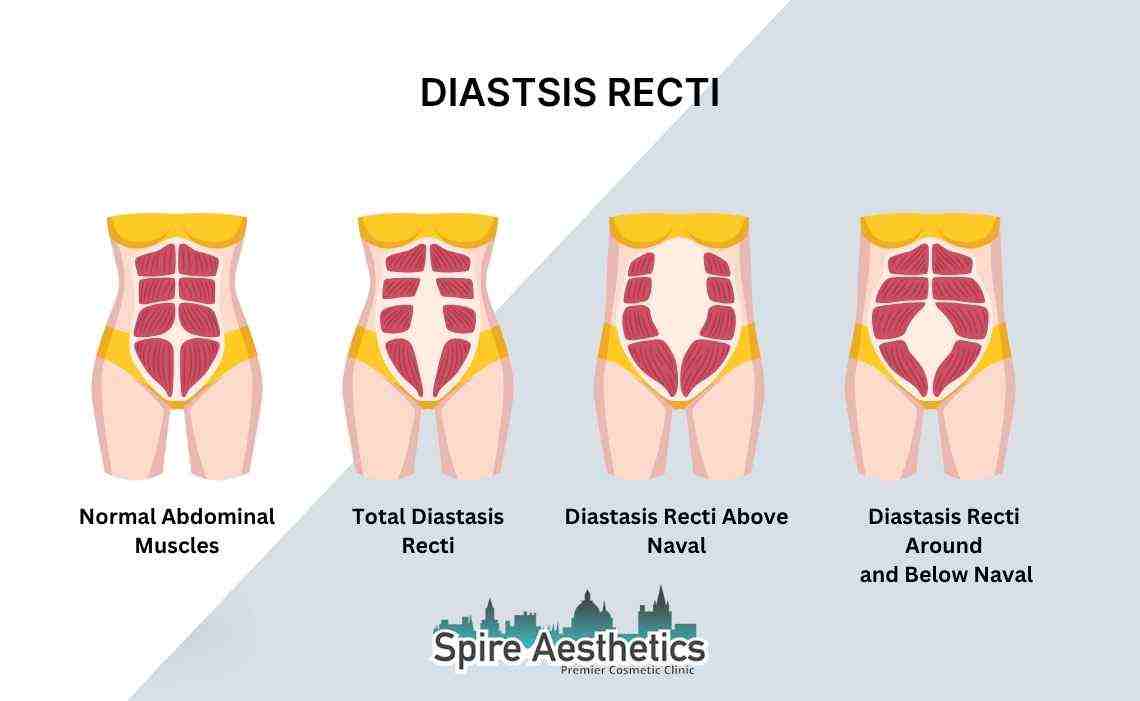 Is Non-Surgical Diastasis Recti Treatment Right for You? Common Concerns Answered Sunningdale